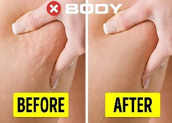 درمان سلولیت با متد ایکس‌بادی