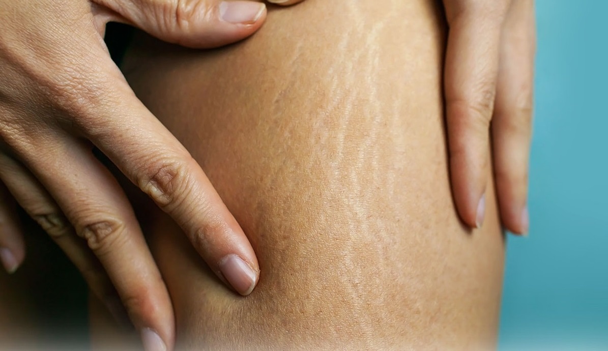 درمان سلولیت با متد ایکسبادی